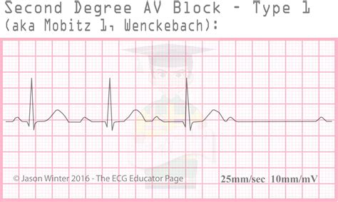 ECG Educator Blog : Heart Blocks