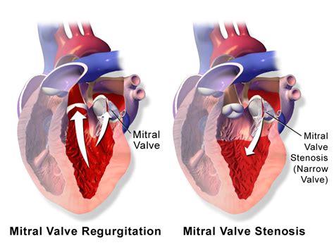 Rheumatic Heart Disease is the most common form of heart disease found ...