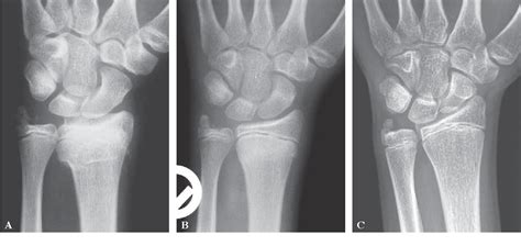 Figure 1 from Fracture of the ulnar styloid process negatively ...