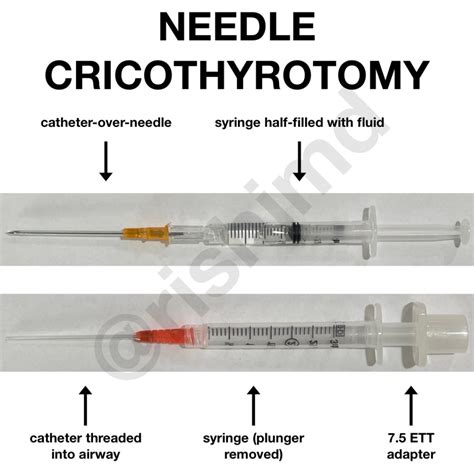 Needle Cricothyrotomy | RK.MD