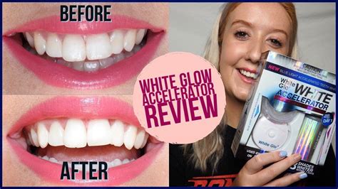 Blue Light Teeth Whitening Before And After - TeethWalls