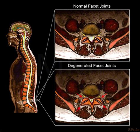 Color MRI Lumbar Spine Facet Arthritis