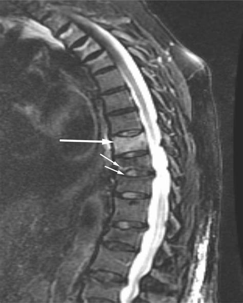 An 84-year-old woman with steroid-related osteoporosis and a 4-week ...