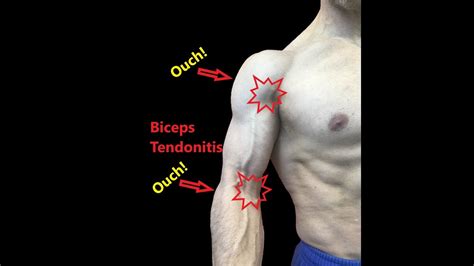 biceps tendonitis exercises pdf uk - Birdie Nagel