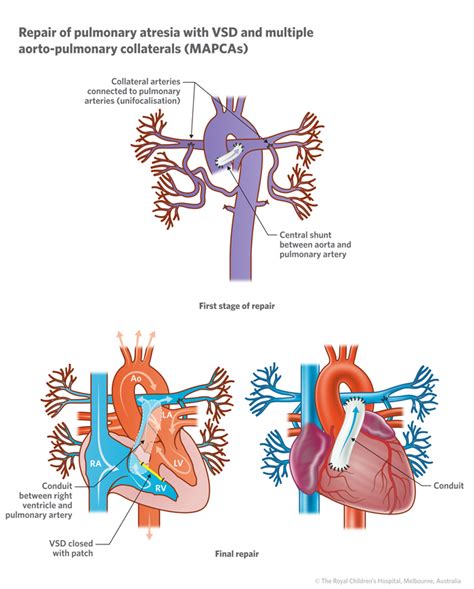 Play It Where It Lies: Congenital Heart Defect--Pulmonary Atresia