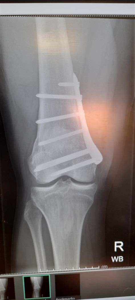 Genu valgum deformity corrective surgery : r/XRayPorn