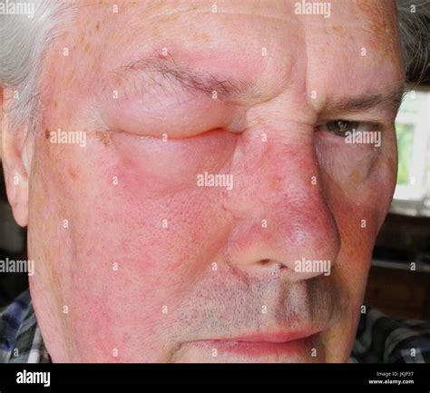 The image shows an allergic reaction to a wasp, bee, hornet, insect sting. The reaction to a ...