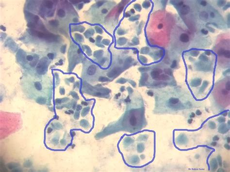 THE PERUVIAN CYTOPATHOLOGY CORNER: CITOLOGIA CERVICAL: TRICHOMONAS