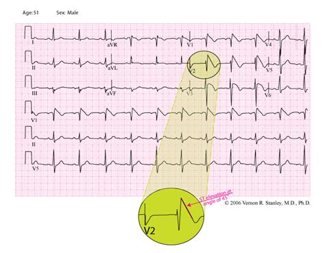 The Brugada Syndrome vs STEMI Mimic - ECGcourse.com