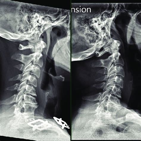 MRI cervical spine revealing of advanced cervical degenerative disc... | Download Scientific Diagram