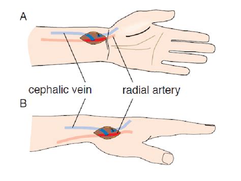 Dialysis Fistula Placement