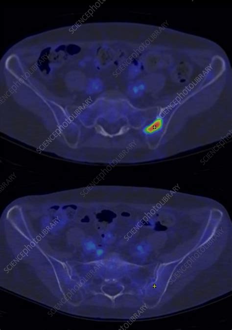 Non-Hodgkin lymphoma, CT-PET scan - Stock Image - C057/5235 - Science Photo Library