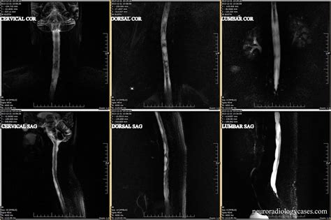 Dr Balaji Anvekar FRCR: Focal Adhesive Arachnoiditis of Spinal Cord