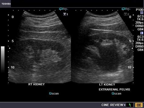 cochinblogs: Extrarenal pelvis: