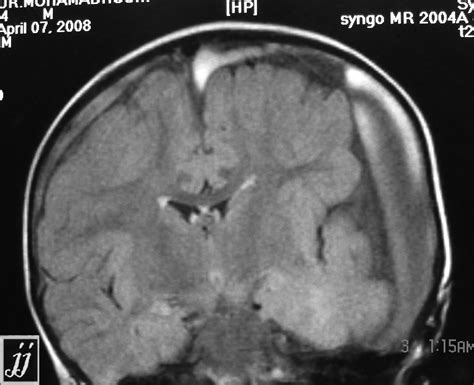 Subdural hygroma – Radiopaedia