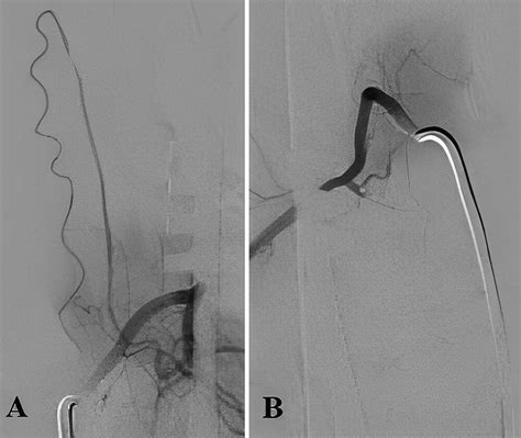 Intraoperative intraarterial indocyanine green video-angiography for disconnection of a ...