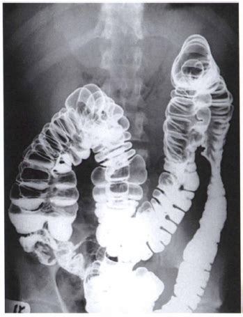 Barium Enema Double Contrast | Preparation | Large Intestine X-Ray - Radiographic Positioning ...