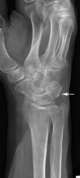 Triquetral Fracture Symptoms