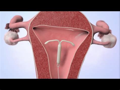 Patient Education Video: Intrauterine Device (IUD) - YouTube