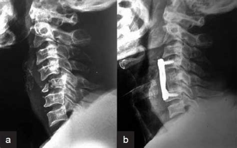 X-ray cervical spine (lateral view) showing (a) C5 frac | Open-i