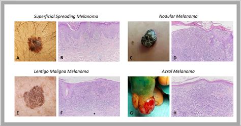 Melanoma Histology