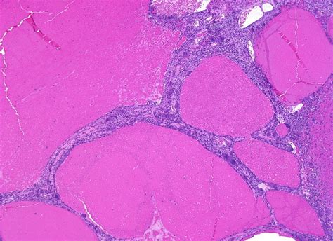 Bone Cyst Histology