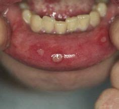 Oral ulcers are a part of Lupus -- these painful sores also manifest ...