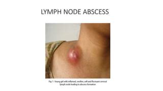 Cold abscess | PPT