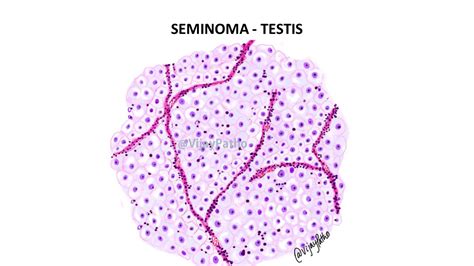 SEMINOMA- TESTIS - Pathology Made Simple