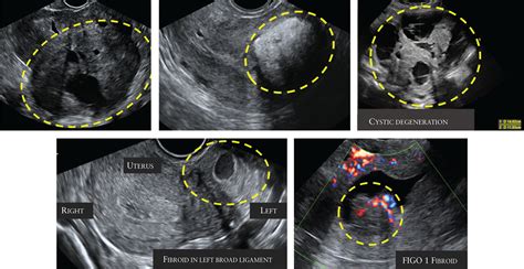 Intramural Fibroid Ultrasound