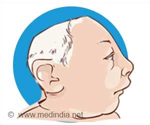 Anencephaly - Causes, Symptoms, Diagnosis and Treatment