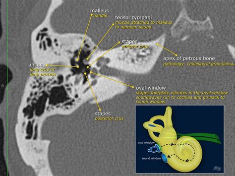 The Radiology Assistant : Temporal bone - Anatomy 2.0 | Radiology ...