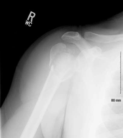 Shoulder and Elbow Surgery: Shoulder subluxation after fixation of proximal humerus fracture