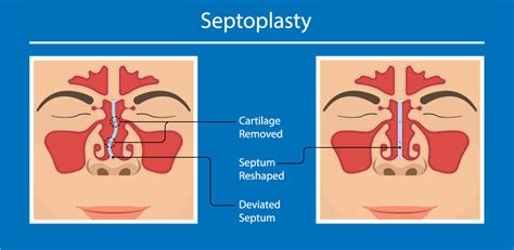 Nasal Blockage | Nose Conditions And Procedures | Worcestershire Ear, Nose & Throat - Mr Lance ...