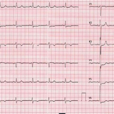 ECG aspect: sinus rhythm, ST-segment depression in V4-V6, T-wave ...