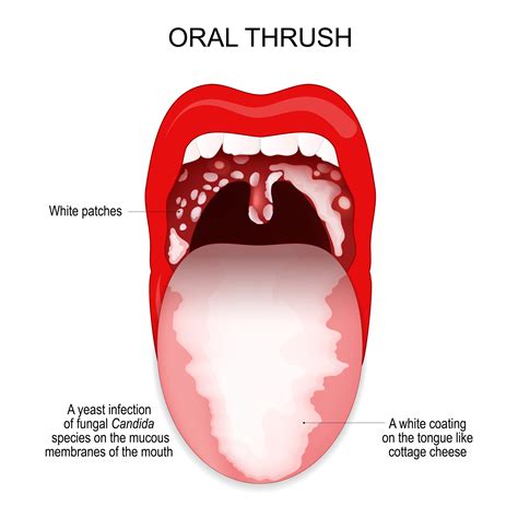 What Does Oral Thrush Look Like? (Pics & Symptoms)