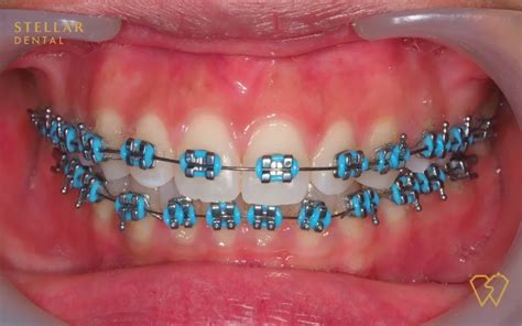 Braces Colors: Top Picks For 2023 - Stellar Dental