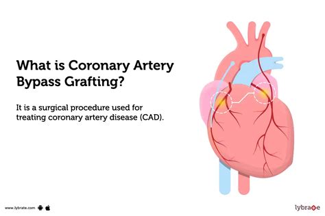 Coronary Artery Bypass Grafting: Purpose, Procedure, Benefits and Side Effects