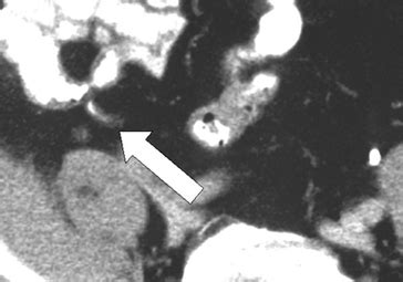 Acute Appendicitis: CT images - Acute Abdomen Tutorial