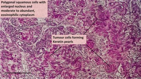 Pathology of Esophageal Squamous cell carcinoma - Pathology Made Simple