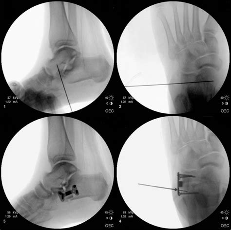 Evans Calcaneal Osteotomy: Assessment of Multiplanar Correction - The ...