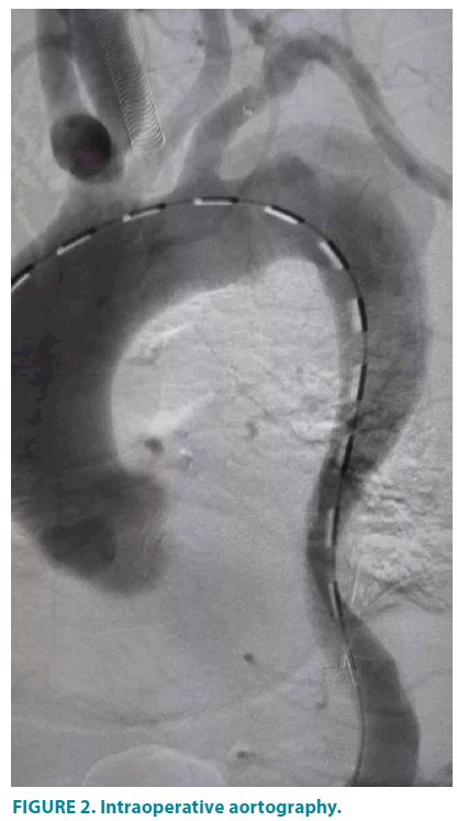 One-stage endovascular management of penetrating thoracic aorta ulcer accompanied by ...