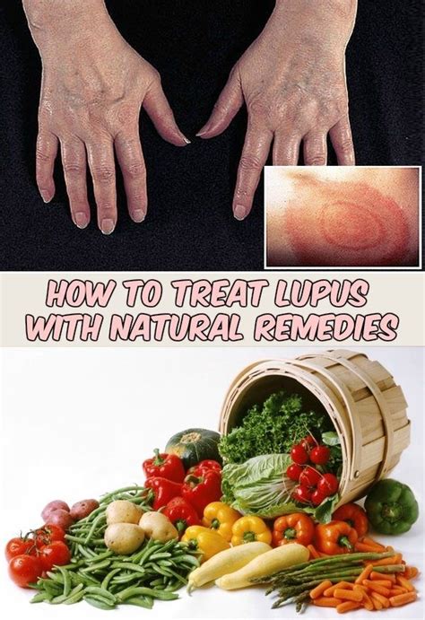 How to Treat Lupus with Natural Remedies | Natural remedies, Remedies ...