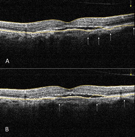 Macular OCT scan of a subject with age-related macular degeneration.... | Download Scientific ...