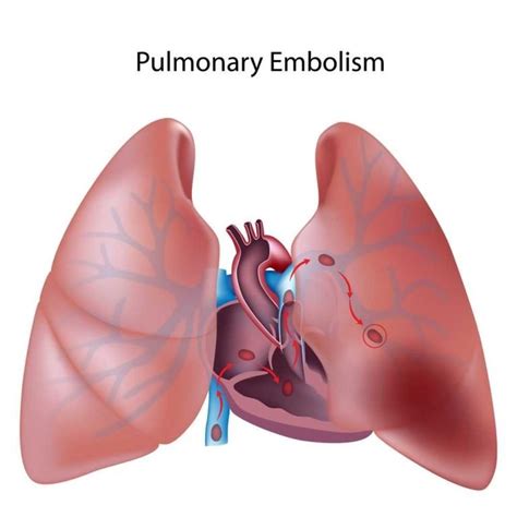 10 Signs of Pulmonary Embolism; Pulmonary Embolism Symptoms