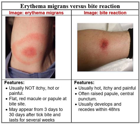 Allergic Reaction To Tick Bites