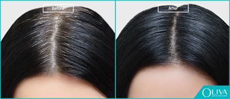 PCOS Hair Loss: Best Treatments Regrow Los Hair