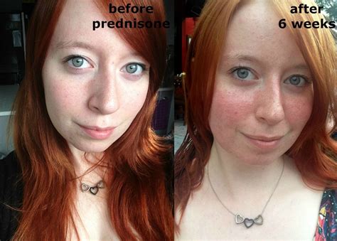 I've been on 40g of prednisone daily for 6 weeks now. Thought I'd share ...