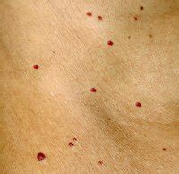 What Those Tiny Red Dots on Your Skin Might Mean » Scary Symptoms