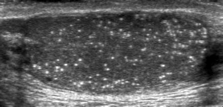 Ultrasonographic image of testicular microlithiasis: gr | Open-i